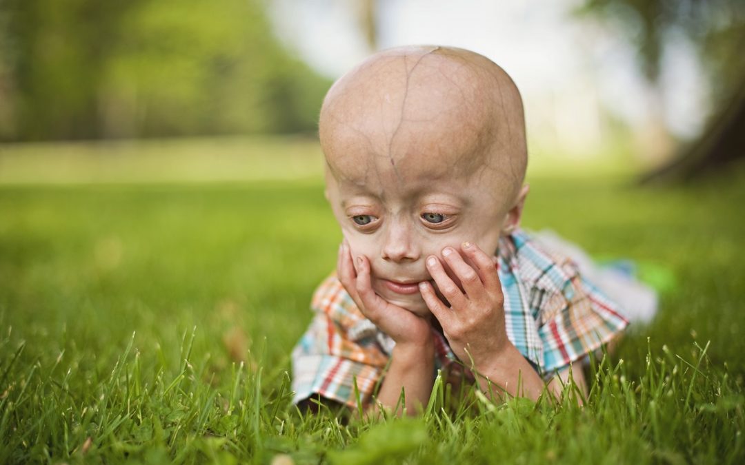 Out of the Shadows: Putting Children with Progeria at the Forefront of Disease-Related Research